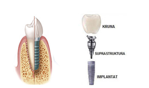 mini implanatI