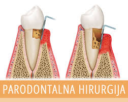 Parodontoloska hirurgija