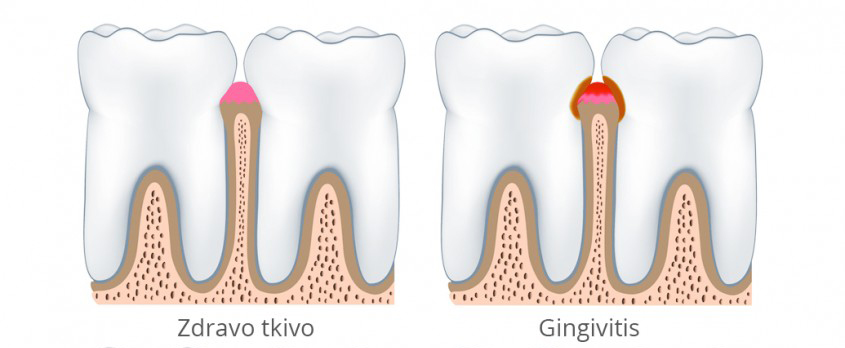 Ginigivitis