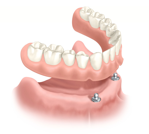 mini-implants